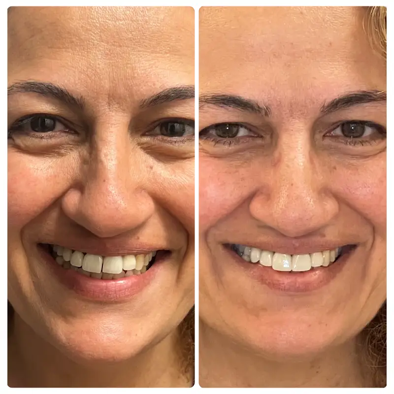 Dental Crown Before & After