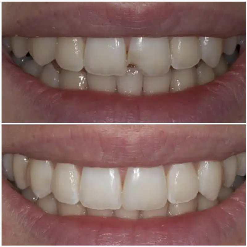 Dental Fillings Before & After