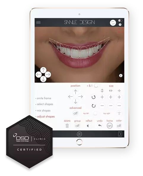 Digital Smile Design Patient Example