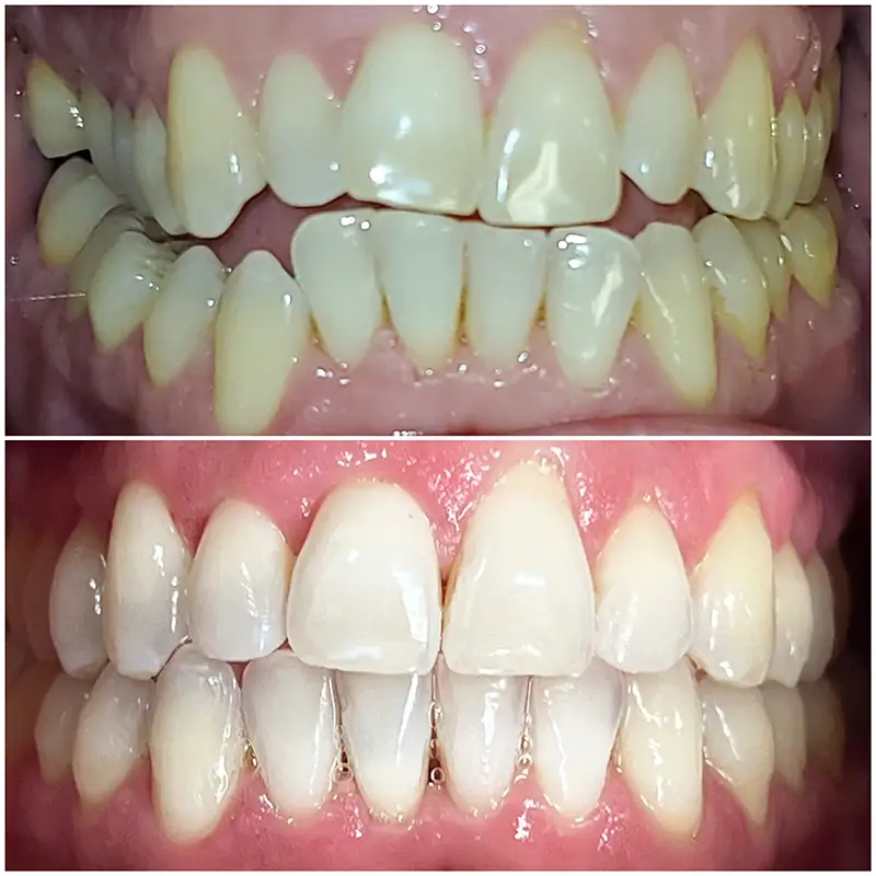 Invisalign Before & After 2