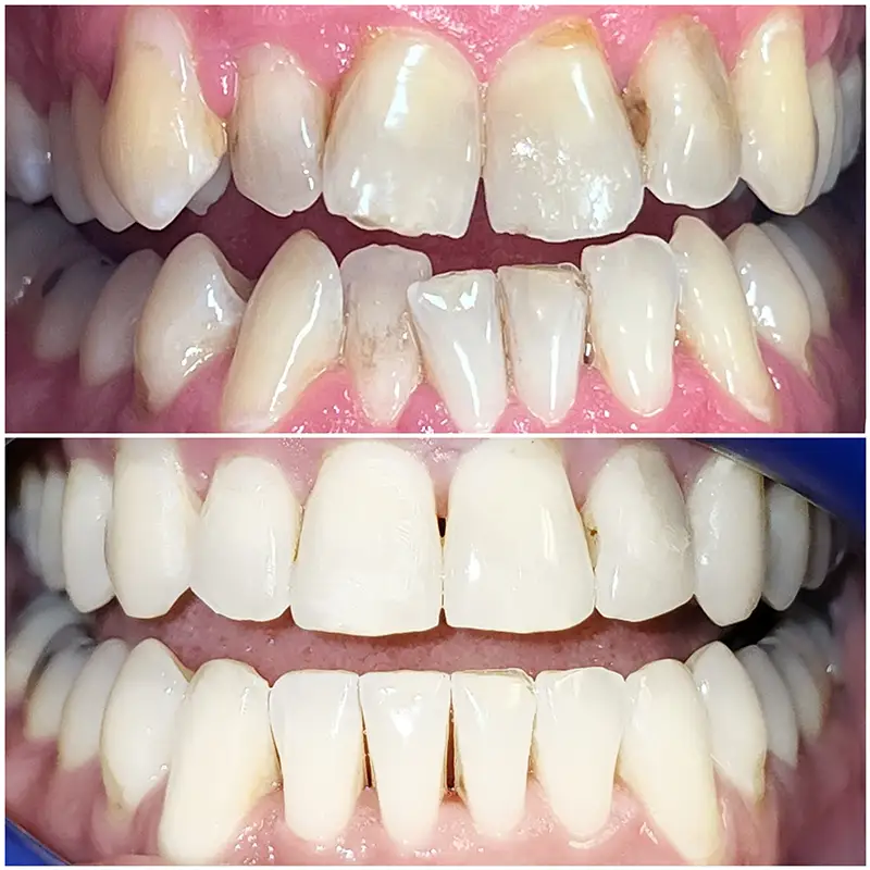 Invisalign Before & After 3