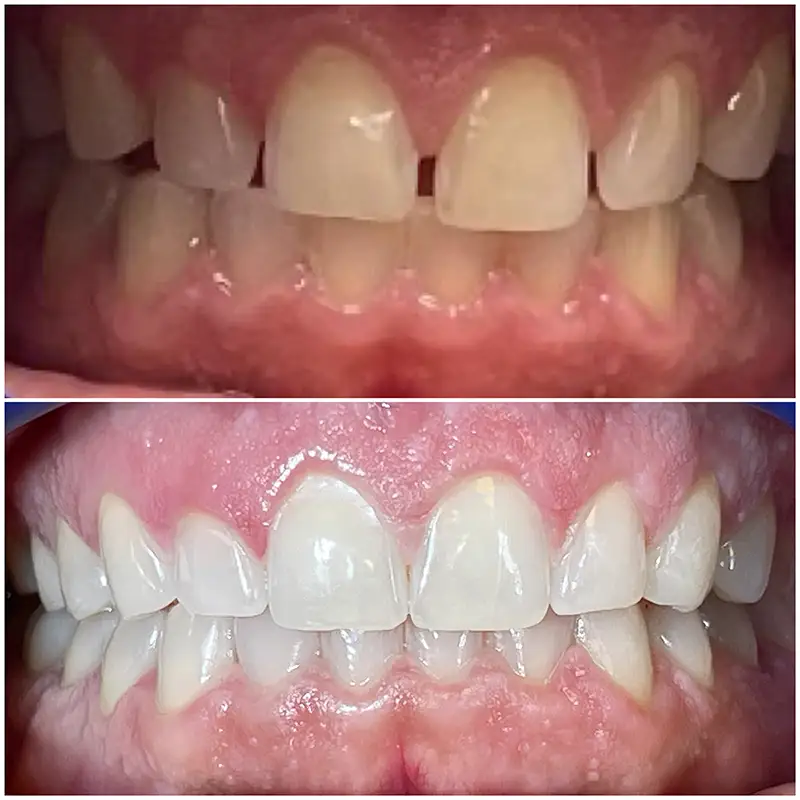 Invisalign Before & After 4