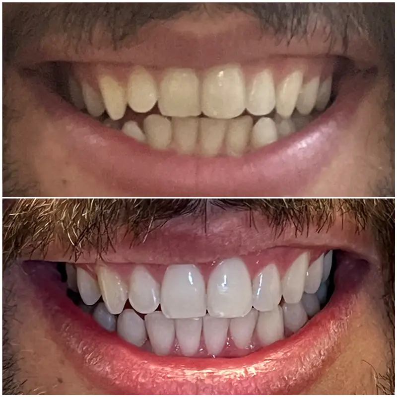 Invisalign Before & After 5