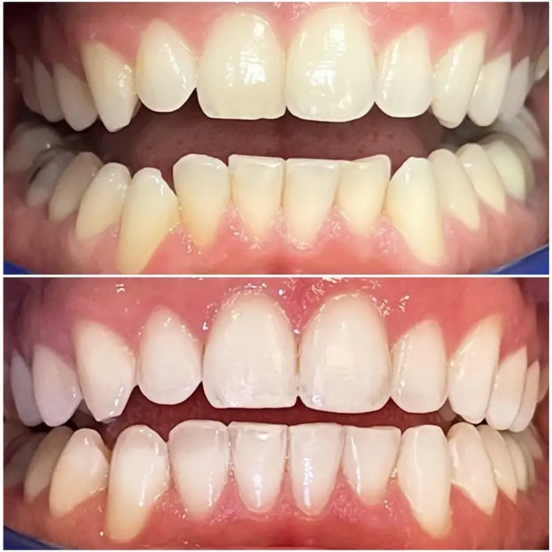 Invisalign Before & After 6