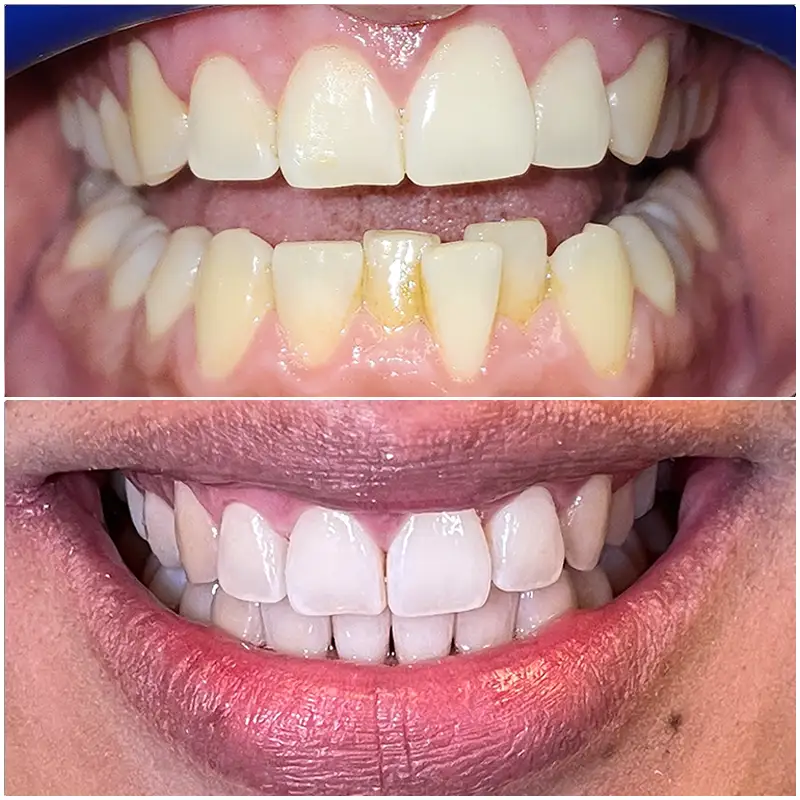 Invisalign Before & After 7